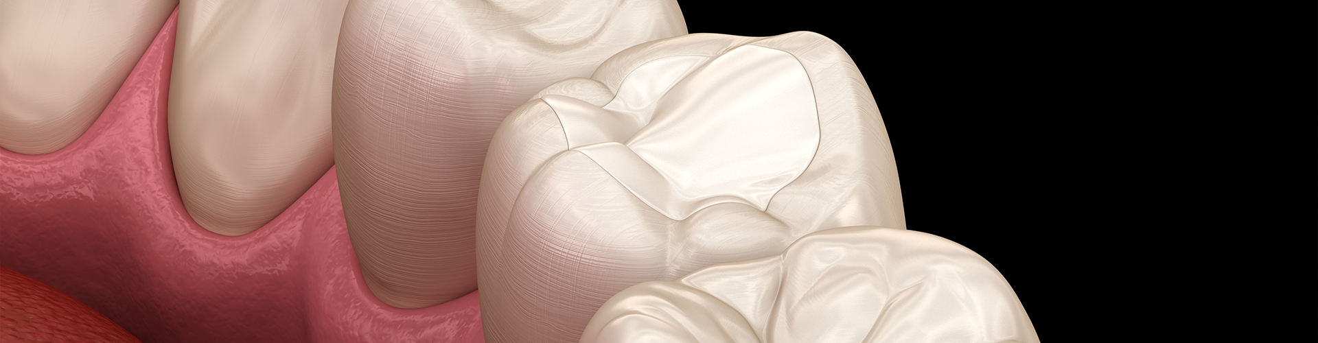 rendering of white material in hole in tooth